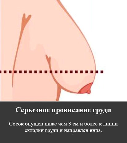 Виды провисния 3